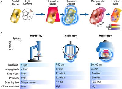 Optoacoustic biomarkers of lipids, hemorrhage and inflammation in carotid atherosclerosis